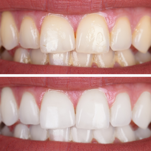 Blanchiment dentaire avant après - résultats visibles chez skincare by Zoé